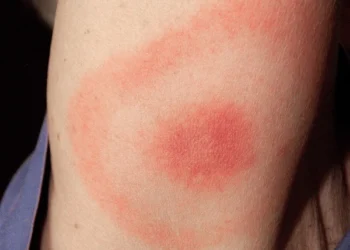 Când ar putea apărea pe piață vaccinul împotriva bolii Lyme