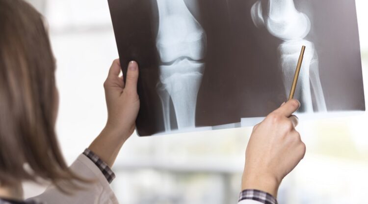 Chistul anevrismal osos – cauze, diagnostic si optiuni terapeutice