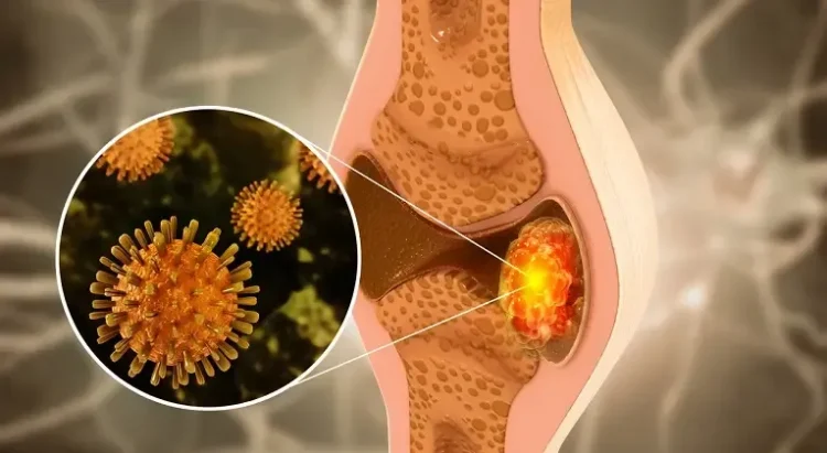 Tratamentul tumorilor osoase