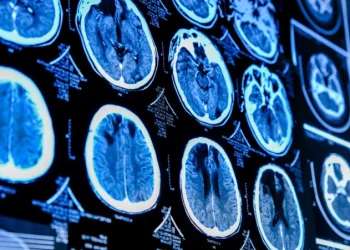 O dietă de proastă calitate poate duce la modificări ale creierului asociate cu depresia și anxietatea, potrivit unui studiu