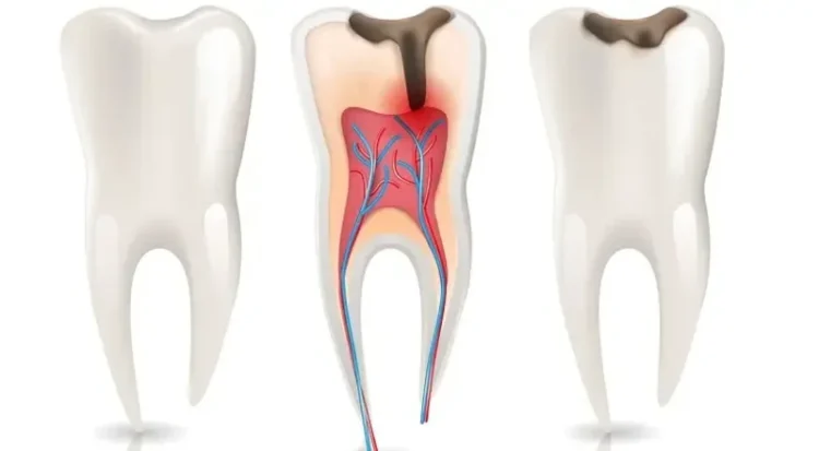 Cele mai frecvente cauze ale inflamatiei pulpare si cum pot fi prevenite
