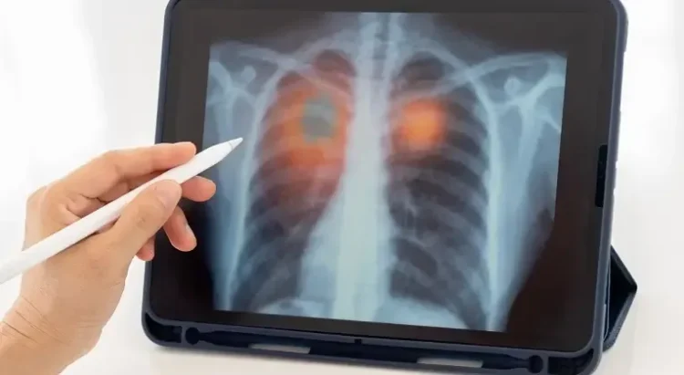 Cancerul pulmonar microcelular – evolutie si tratament