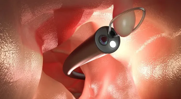 Colonoscopia: ghid complet pentru pregatire si prevenirea cancerului colorectal