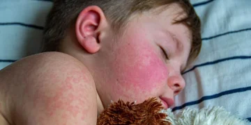 Rata vaccinării copiilor a scăzut alarmant. Se înmulțesc cazurile de rujeolă